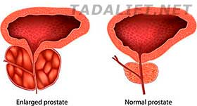 Benign Prostatic Hyperplasia Symptoms