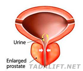 Prostate Infection 