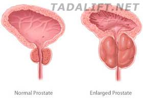 prostatitis: causes, symptoms, and possible consequences